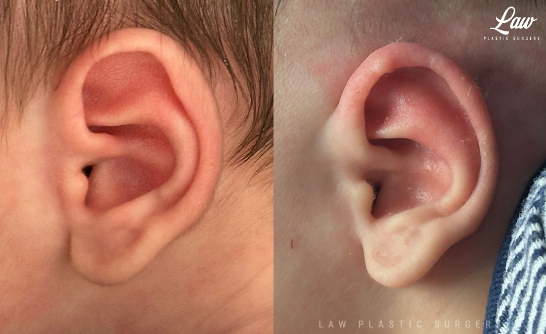 Ear Molding Before and After Photo. Surgery performed in Dallas, TX at Law Plastic Surgery.