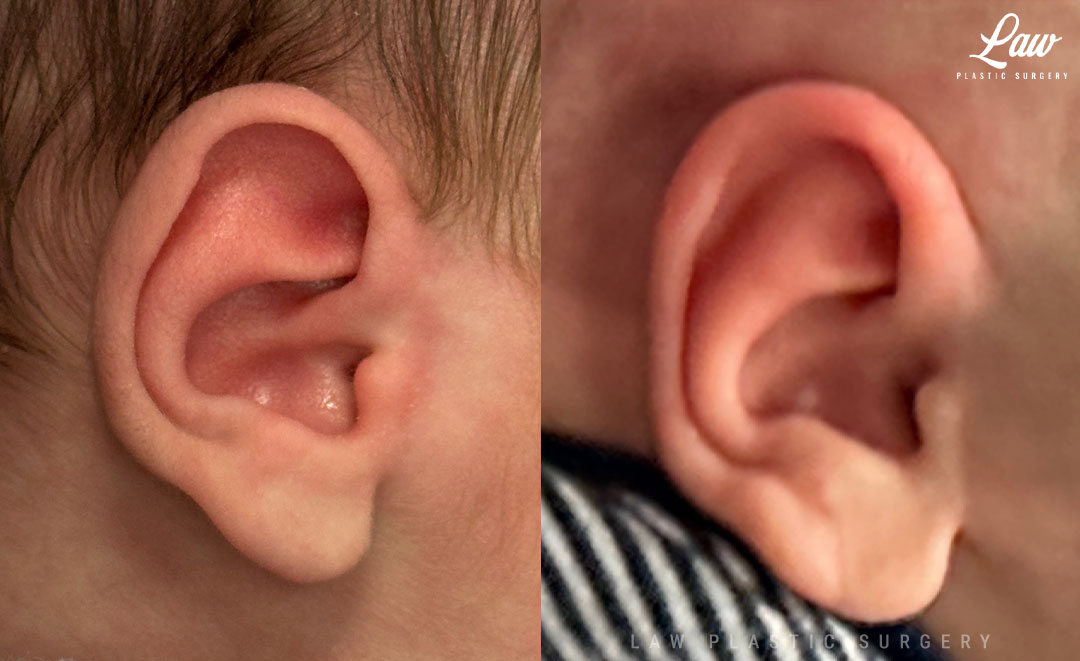 Ear Molding Before and After Photo. Surgery performed in Dallas, TX at Law Plastic Surgery.