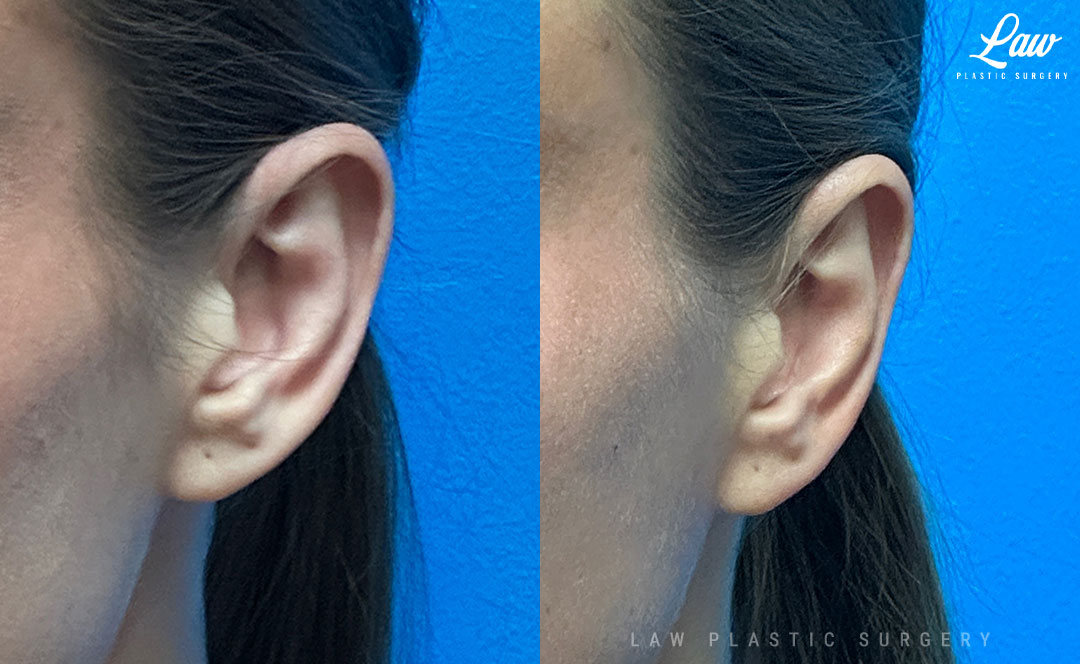  Ear Surgery (Otoplasty) Before & After Photo. Surgery performed in Dallas, TX at Law Plastic Surgery.