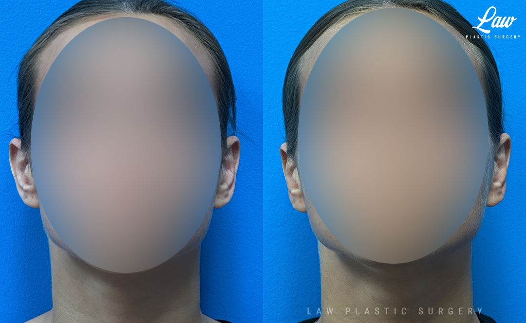 Ear Surgery (Otoplasty) Before & After Photo. Surgery performed in Dallas, TX at Law Plastic Surgery.