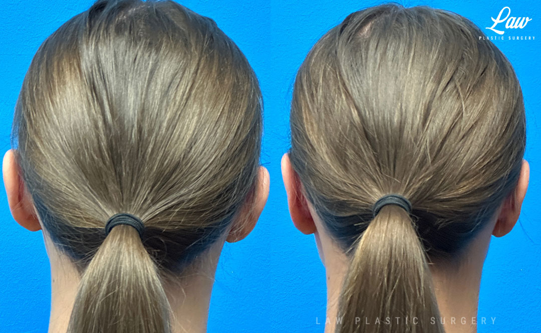 Ear Surgery (Otoplasty) Before & After Photo. Surgery performed in Dallas, TX at Law Plastic Surgery.