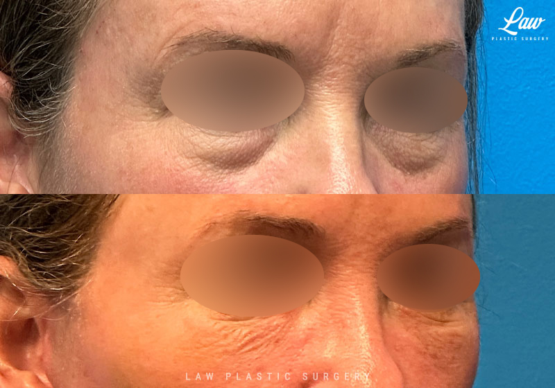 Eyelid Surgery (Blepharoplasty) Before & After Photo. Surgery performed in Dallas, TX at Law Plastic Surgery.