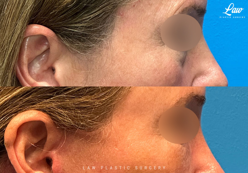 Eyelid Surgery (Blepharoplasty) Before & After Photo. Surgery performed in Dallas, TX at Law Plastic Surgery.