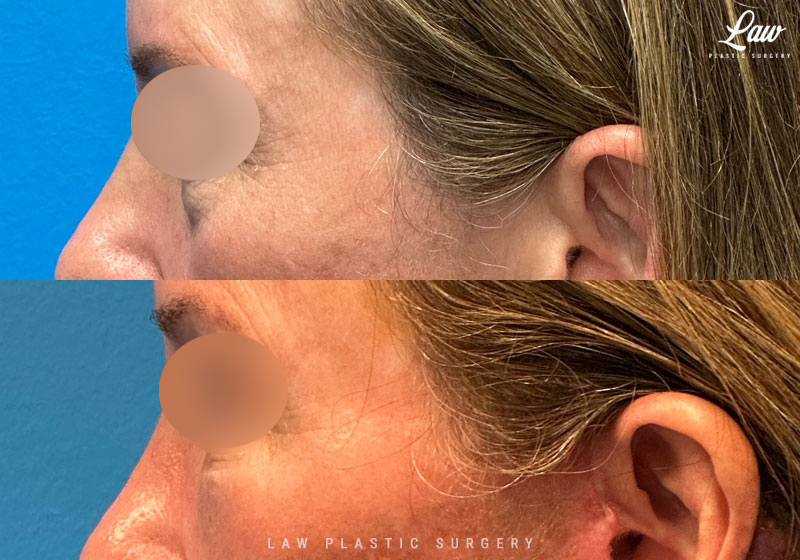 Eyelid Surgery (Blepharoplasty) Before & After Photo. Surgery performed in Dallas, TX at Law Plastic Surgery.