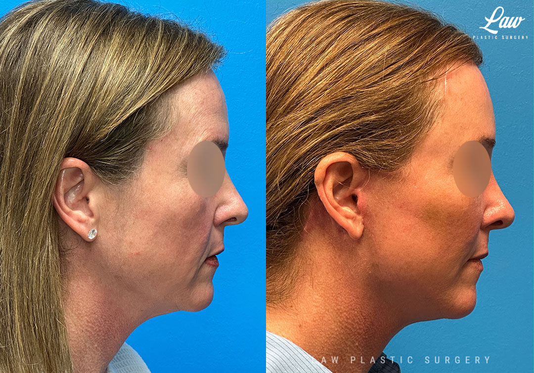Facelift Before & After Photos. Surgery performed in Dallas, TX at Law Plastic Surgery.