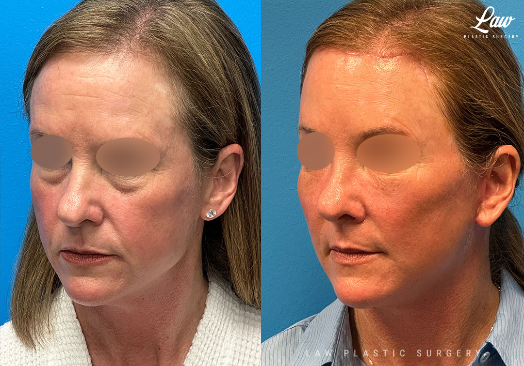 Facelift Before & After Photos. Surgery performed in Dallas, TX at Law Plastic Surgery.