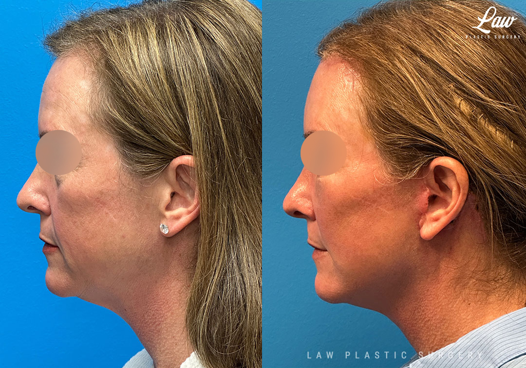 Facelift Before & After Photos. Surgery performed in Dallas, TX at Law Plastic Surgery.