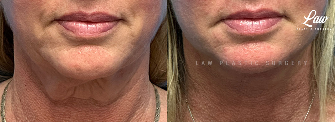 Neck Lift Before & After Photos. Surgery performed in Dallas, TX at Law Plastic Surgery.