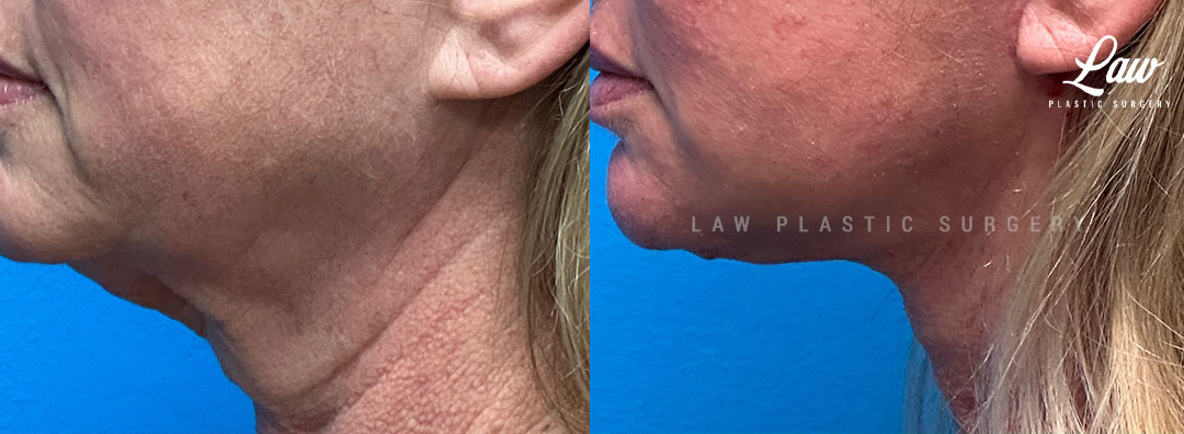 Neck Lift Before & After Photos. Surgery performed in Dallas, TX at Law Plastic Surgery.