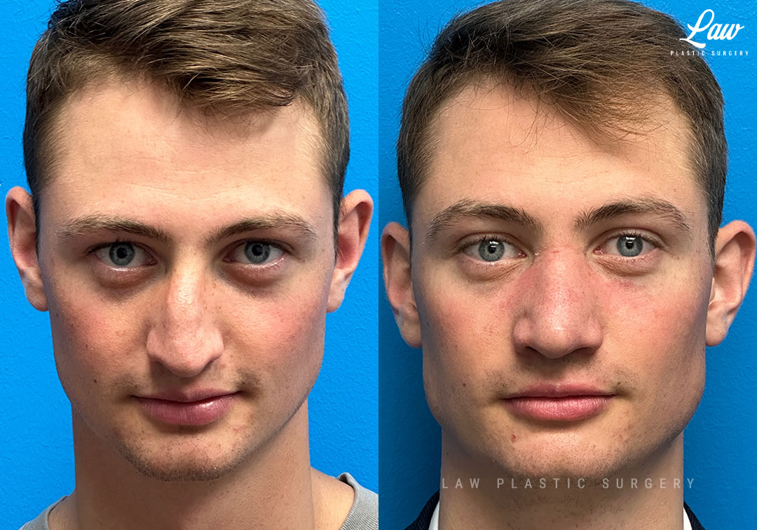 Rhinoplasty (Nose Job) Before & After Photo. Surgery performed in Dallas, TX at Law Plastic Surgery.