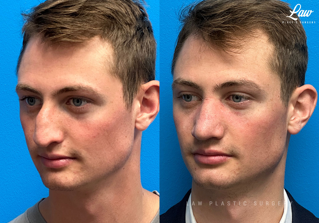 Rhinoplasty (Nose Job) Before & After Photo. Surgery performed in Dallas, TX at Law Plastic Surgery.
