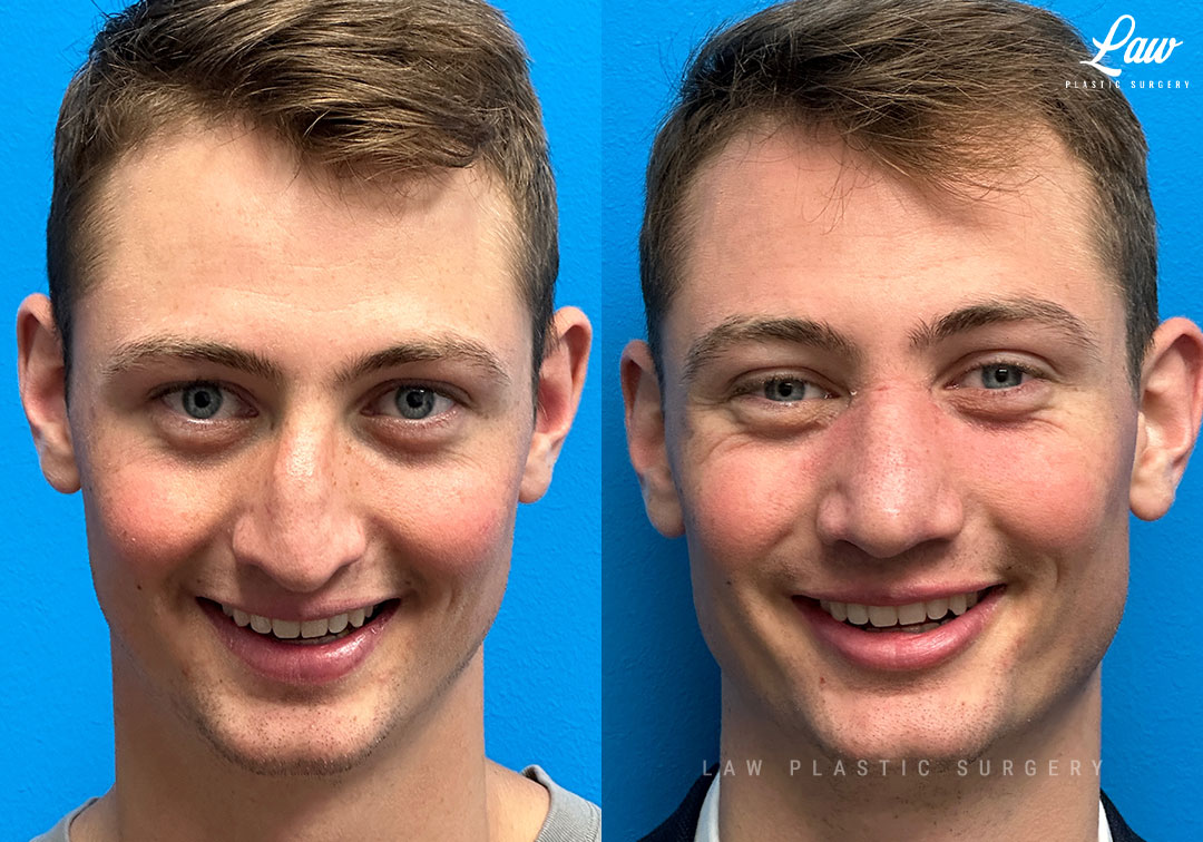 Rhinoplasty (Nose Job) Before & After Photo. Surgery performed in Dallas, TX at Law Plastic Surgery.