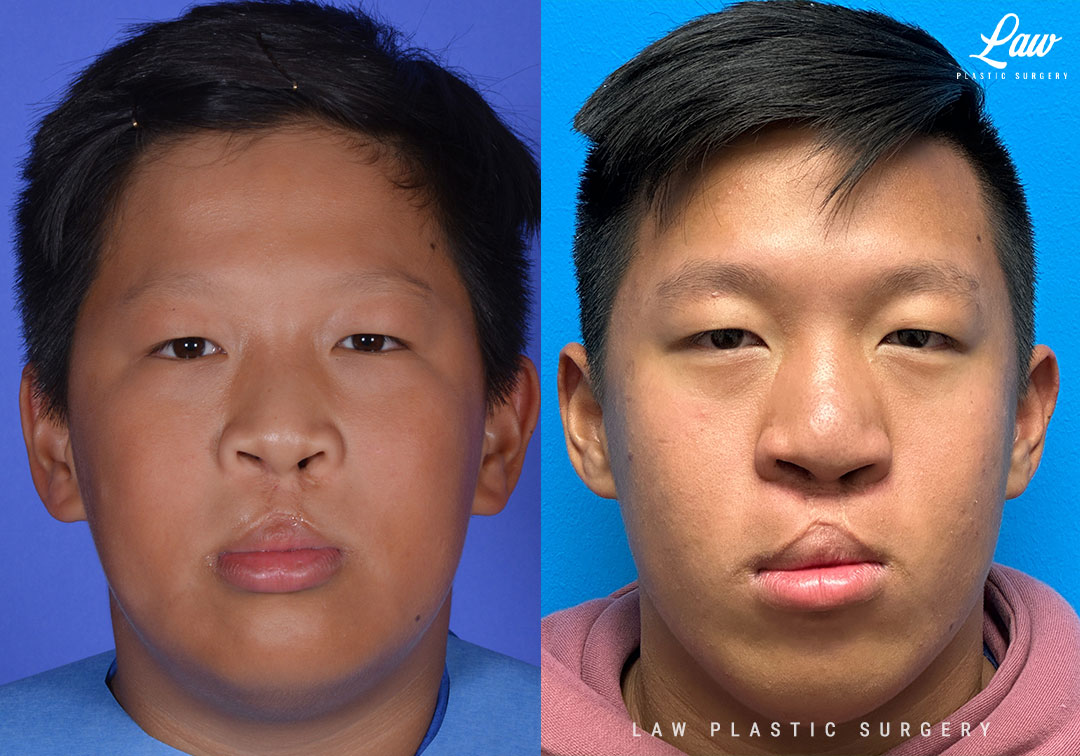 Cleft Rhinoplasty (Cleft Nose Surgery) Before & After Photo. Surgery performed in Dallas, TX at Law Plastic Surgery.