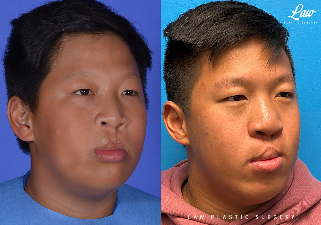Cleft Rhinoplasty (Cleft Nose Surgery) Before & After Photo. Surgery performed in Dallas, TX at Law Plastic Surgery.