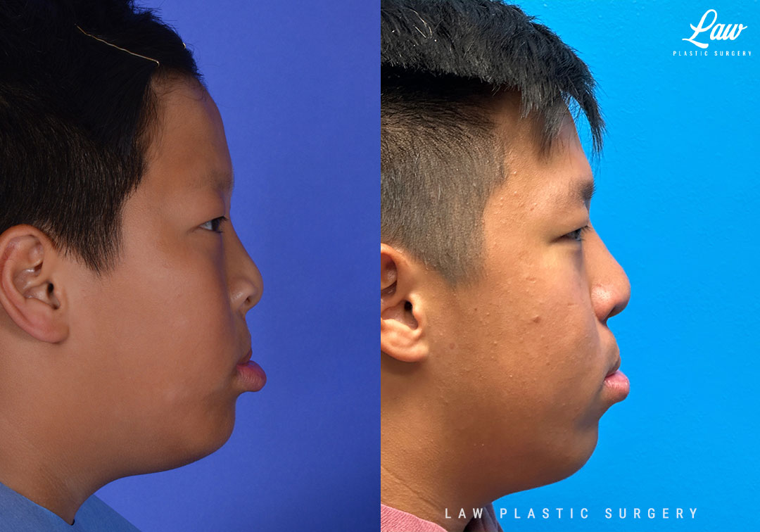 Cleft Rhinoplasty (Cleft Nose Surgery) Before & After Photo. Surgery performed in Dallas, TX at Law Plastic Surgery.