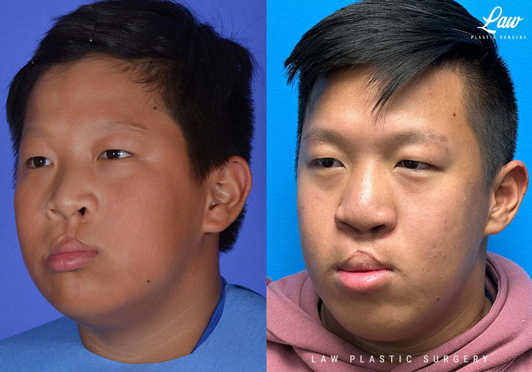 Cleft Rhinoplasty (Cleft Nose Surgery) Before & After Photo. Surgery performed in Dallas, TX at Law Plastic Surgery.