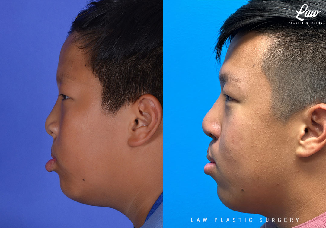 Cleft Rhinoplasty (Cleft Nose Surgery) Before & After Photo. Surgery performed in Dallas, TX at Law Plastic Surgery.