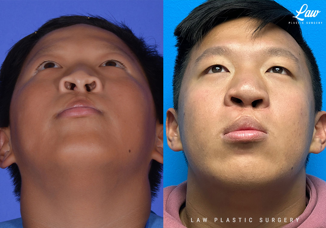 Cleft Rhinoplasty (Cleft Nose Surgery) Before & After Photo. Surgery performed in Dallas, TX at Law Plastic Surgery.
