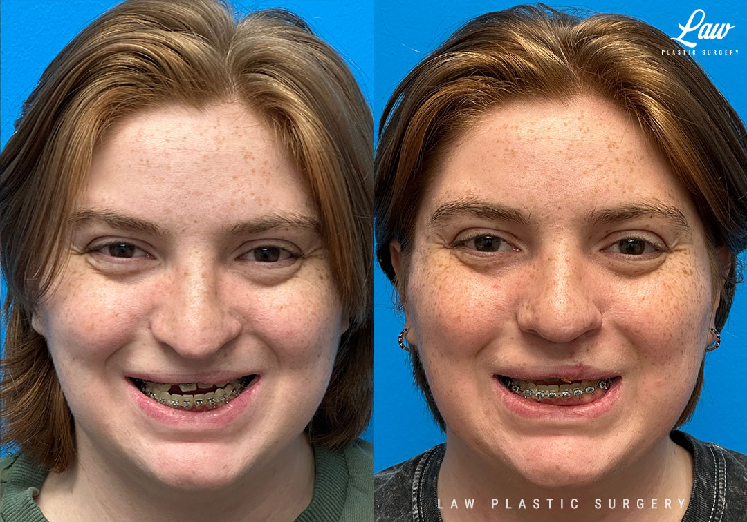 Cleft Rhinoplasty (Cleft Nose Surgery) Before & After Photo. Surgery performed in Dallas, TX at Law Plastic Surgery.