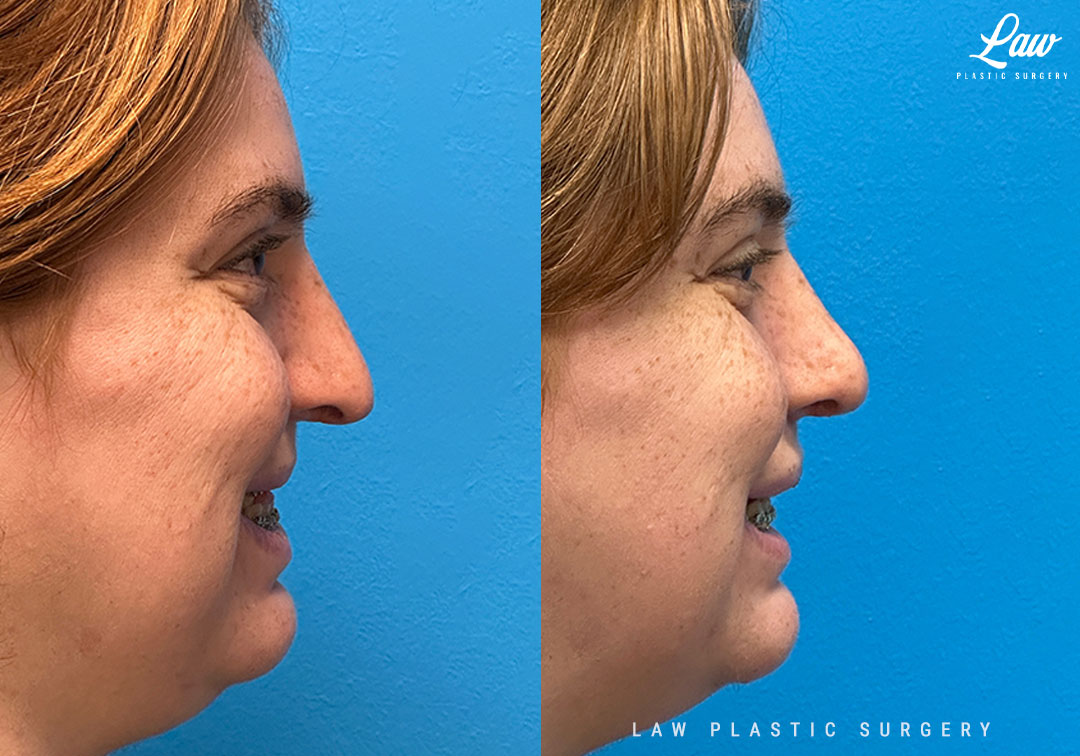 Cleft Rhinoplasty (Cleft Nose Surgery) Before & After Photo. Surgery performed in Dallas, TX at Law Plastic Surgery.
