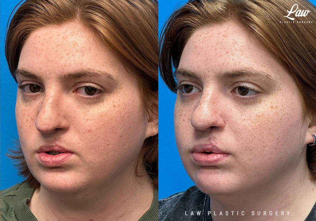 Cleft Rhinoplasty (Cleft Nose Surgery) Before & After Photo. Surgery performed in Dallas, TX at Law Plastic Surgery.