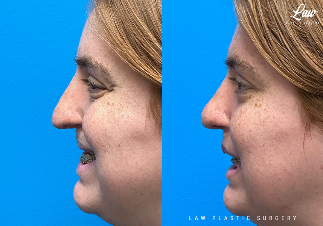 Cleft Rhinoplasty (Cleft Nose Surgery) Before & After Photo. Surgery performed in Dallas, TX at Law Plastic Surgery.
