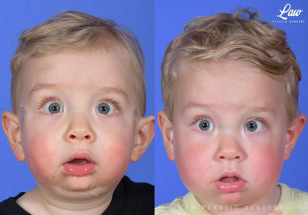 Jaw Distraction Before and After Photo. Surgery performed in Dallas, TX at Law Plastic Surgery.