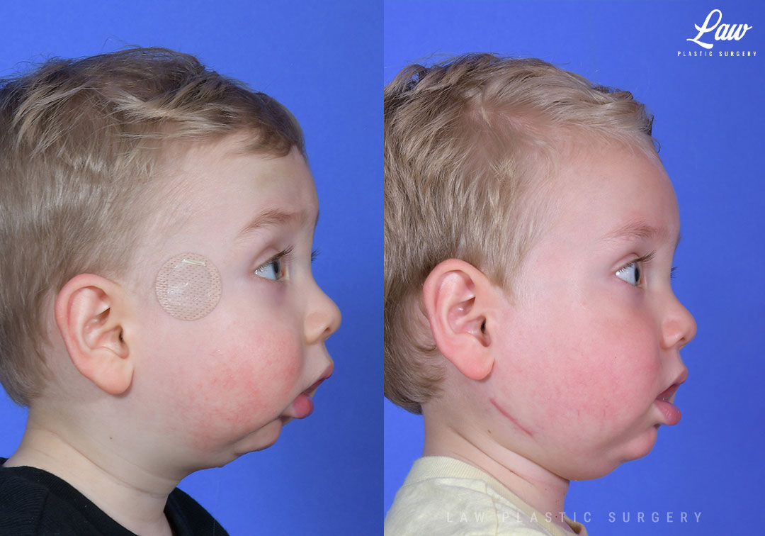 Jaw Distraction Before and After Photo. Surgery performed in Dallas, TX at Law Plastic Surgery.