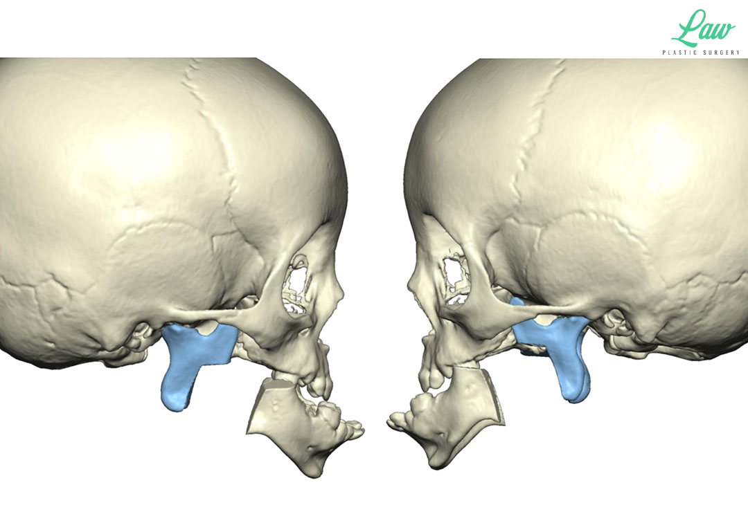 Jaw Distraction Before and After Photo. Surgery performed in Dallas, TX at Law Plastic Surgery.