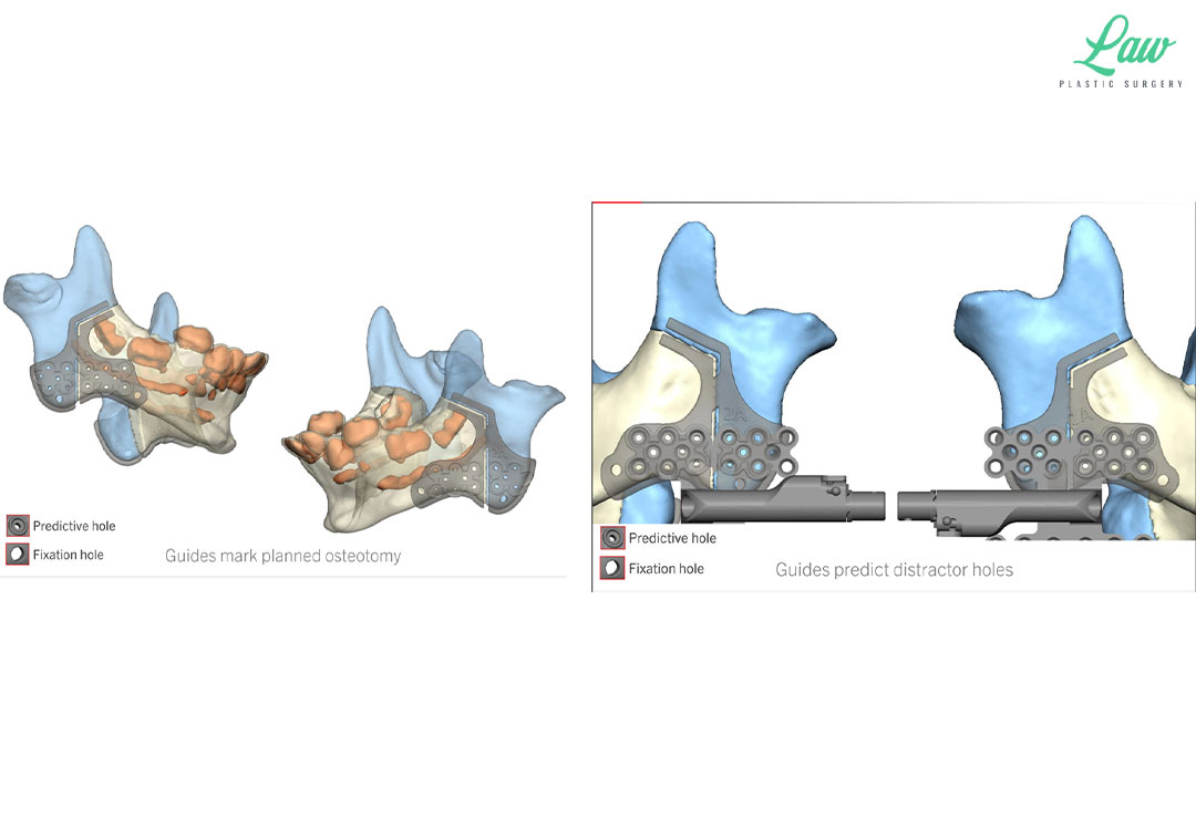 Jaw Distraction Before and After Photo. Surgery performed in Dallas, TX at Law Plastic Surgery.