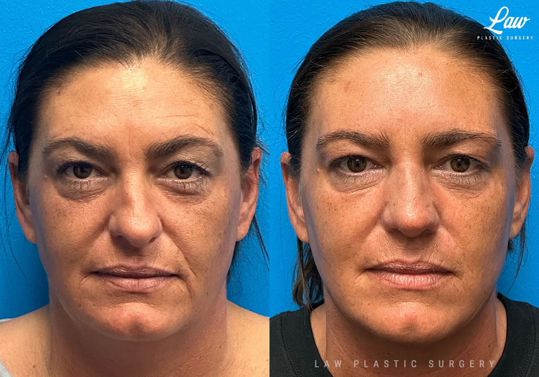 Rhinoplasty (Nose Job) Before & After Photo. Surgery performed in Dallas, TX at Law Plastic Surgery.