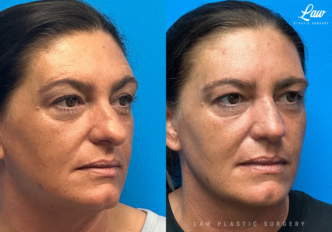 Rhinoplasty (Nose Job) Before & After Photo. Surgery performed in Dallas, TX at Law Plastic Surgery.
