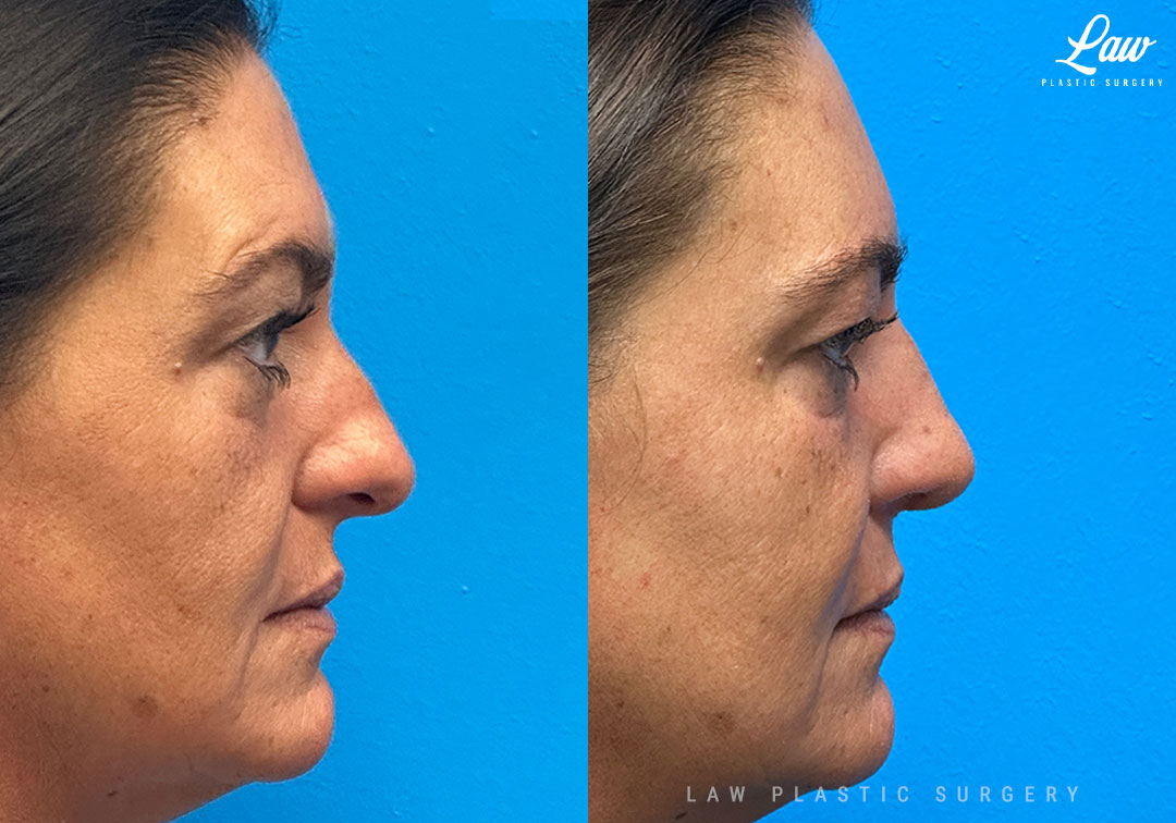 Rhinoplasty (Nose Job) Before & After Photo. Surgery performed in Dallas, TX at Law Plastic Surgery.
