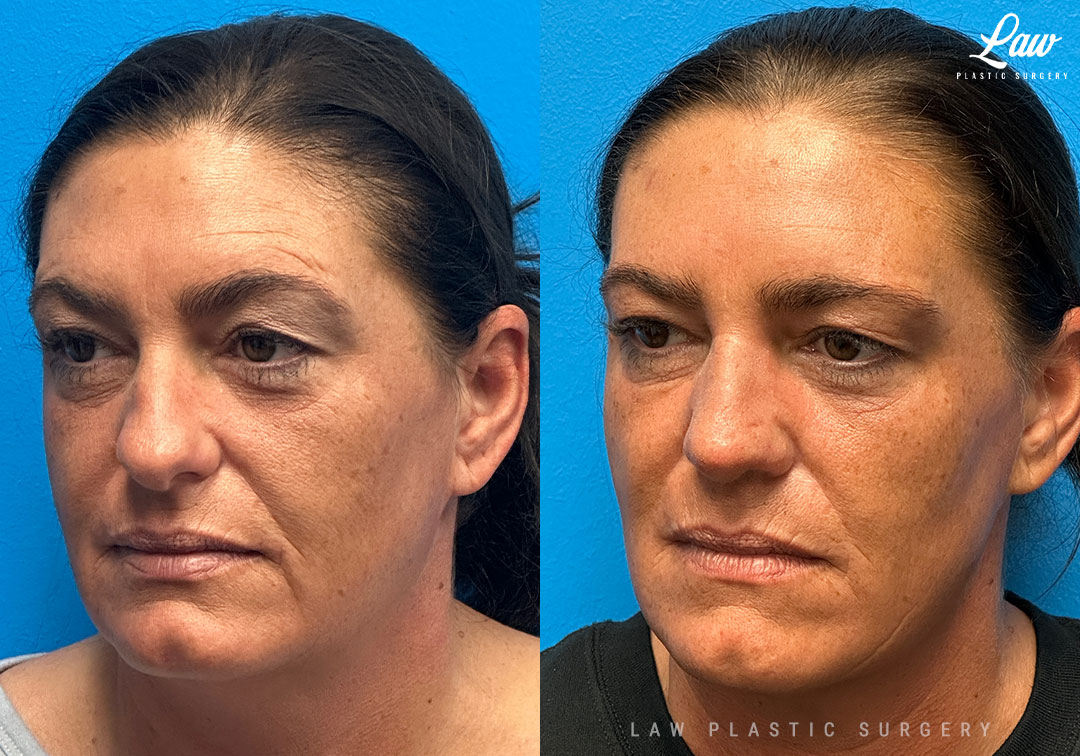 Rhinoplasty (Nose Job) Before & After Photo. Surgery performed in Dallas, TX at Law Plastic Surgery.