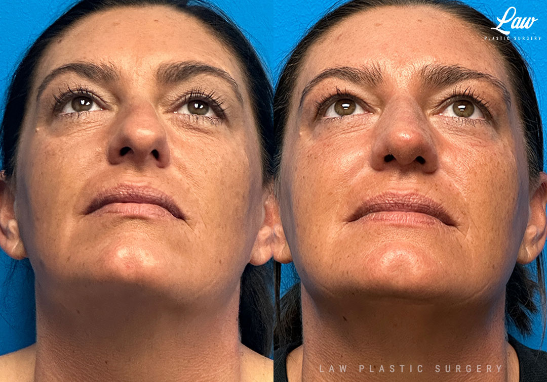 Rhinoplasty (Nose Job) Before & After Photo. Surgery performed in Dallas, TX at Law Plastic Surgery.