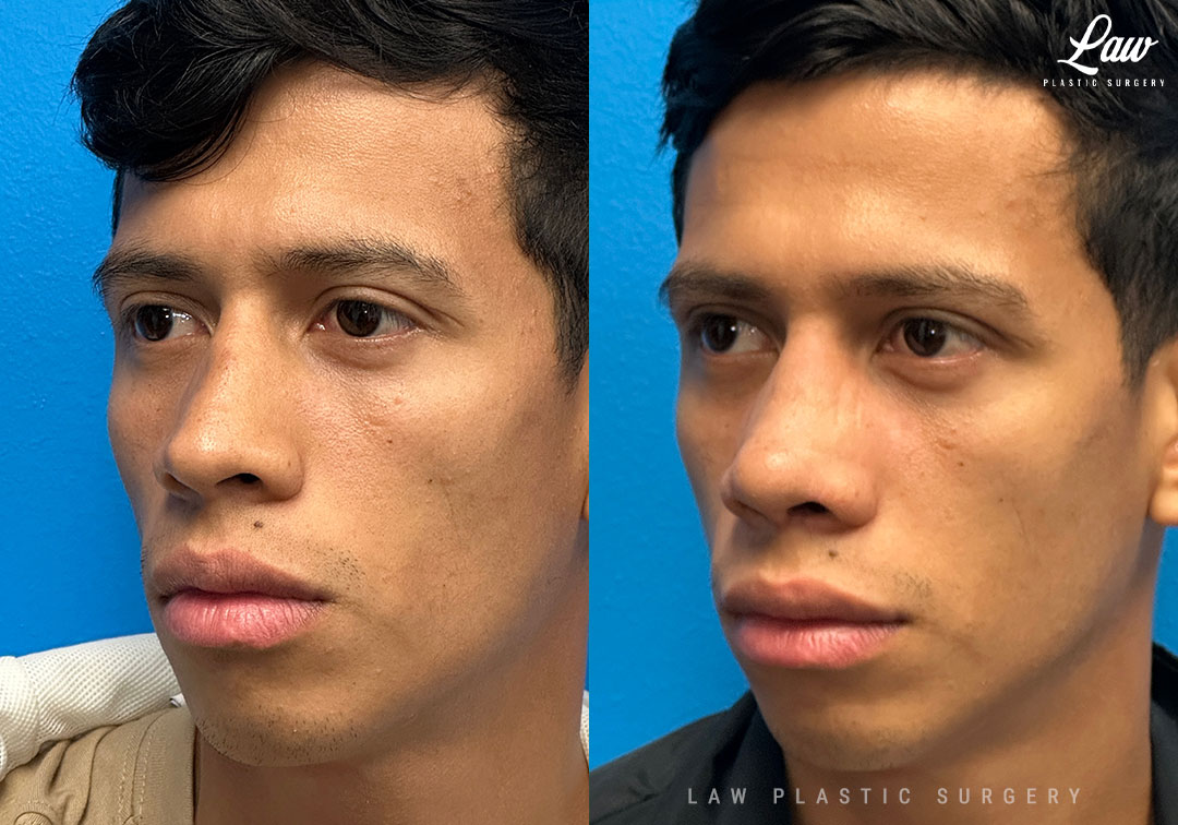 Septoplasty Before & After Photo. Surgery performed in Dallas, TX at Law Plastic Surgery.
