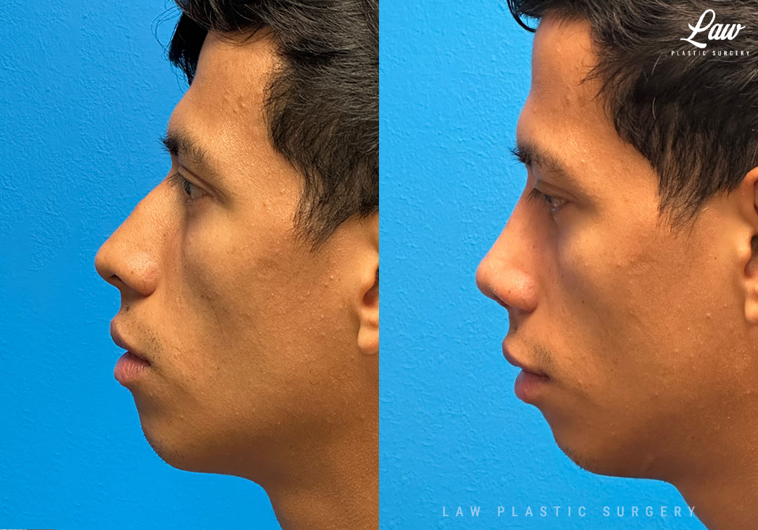 Septoplasty Before & After Photo. Surgery performed in Dallas, TX at Law Plastic Surgery.