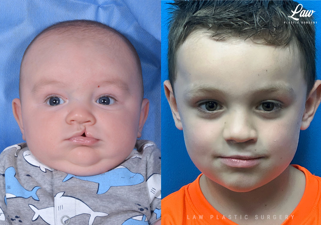 Cleft Lip Repair Before & After Photo. Surgery performed in Dallas, TX at Law Plastic Surgery.