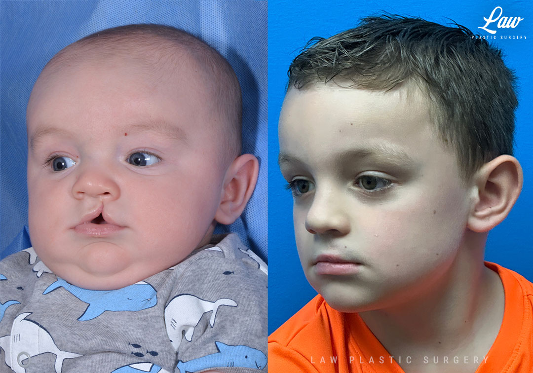 Cleft Lip Repair Before & After Photo. Surgery performed in Dallas, TX at Law Plastic Surgery.