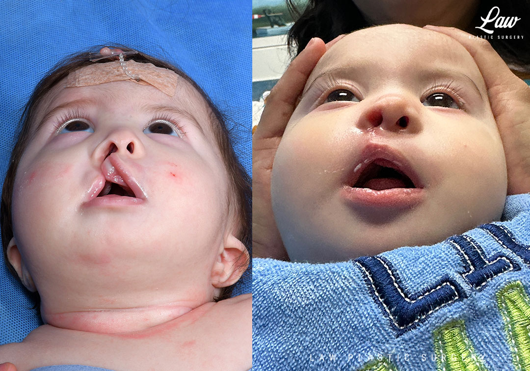 Cleft Lip Repair Before & After Photo. Surgery performed in Dallas, TX at Law Plastic Surgery.