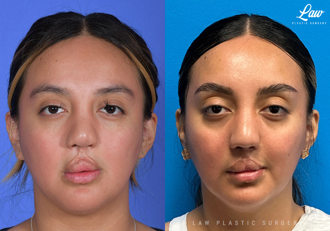 Cleft Rhinoplasty (Cleft Nose Surgery) Before & After Photo. Surgery performed in Dallas, TX at Law Plastic Surgery.