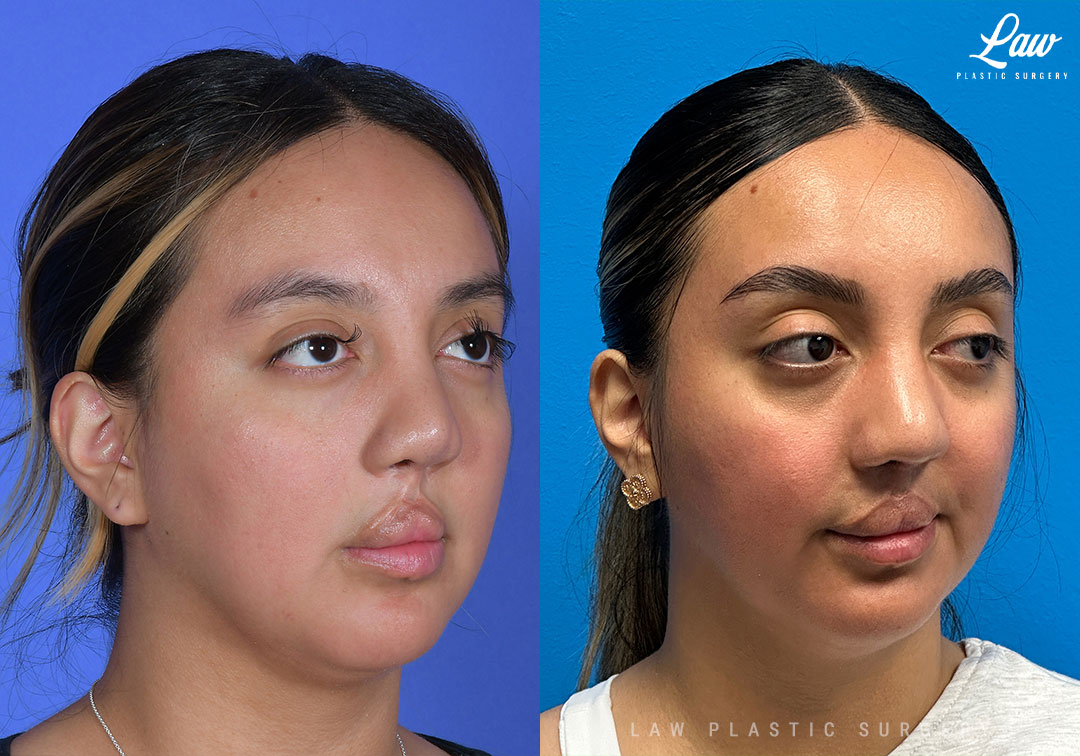 Cleft Rhinoplasty (Cleft Nose Surgery) Before & After Photo. Surgery performed in Dallas, TX at Law Plastic Surgery.
