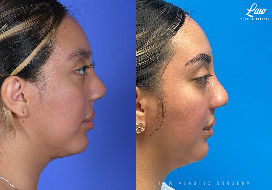 Cleft Rhinoplasty (Cleft Nose Surgery) Before & After Photo. Surgery performed in Dallas, TX at Law Plastic Surgery.