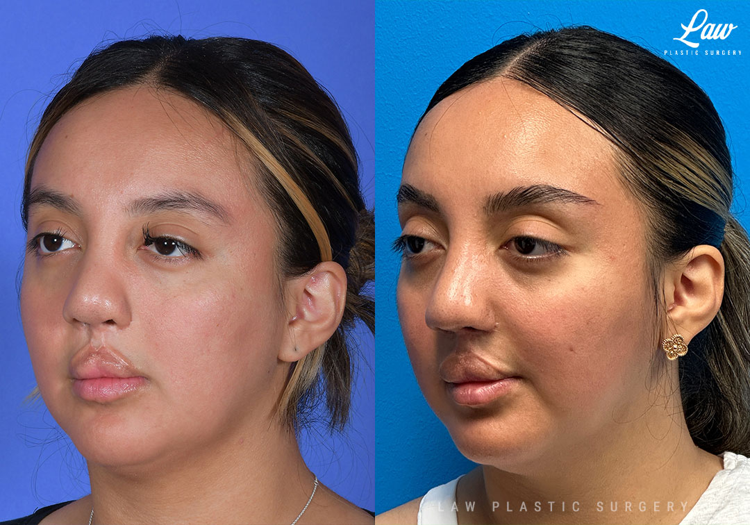 Cleft Rhinoplasty (Cleft Nose Surgery) Before & After Photo. Surgery performed in Dallas, TX at Law Plastic Surgery.