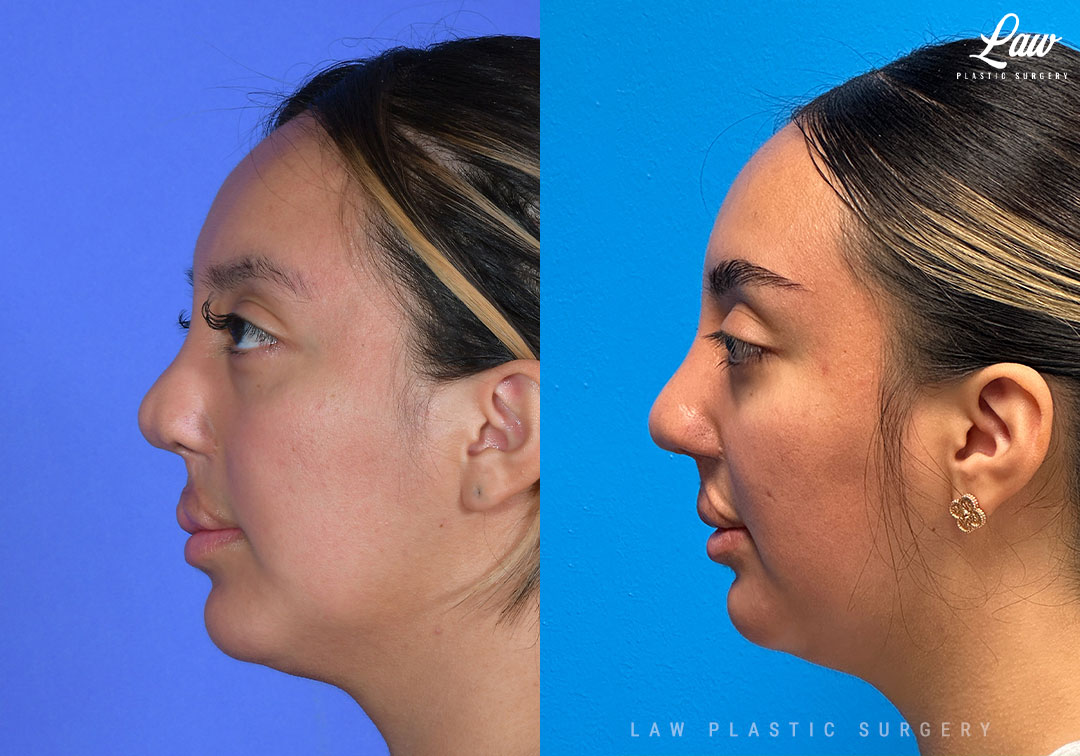 Cleft Rhinoplasty (Cleft Nose Surgery) Before & After Photo. Surgery performed in Dallas, TX at Law Plastic Surgery.