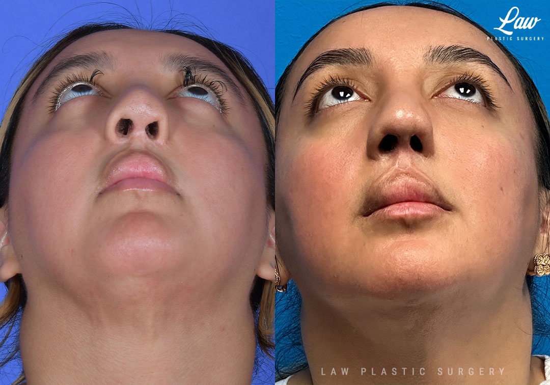 Cleft Rhinoplasty (Cleft Nose Surgery) Before & After Photo. Surgery performed in Dallas, TX at Law Plastic Surgery.