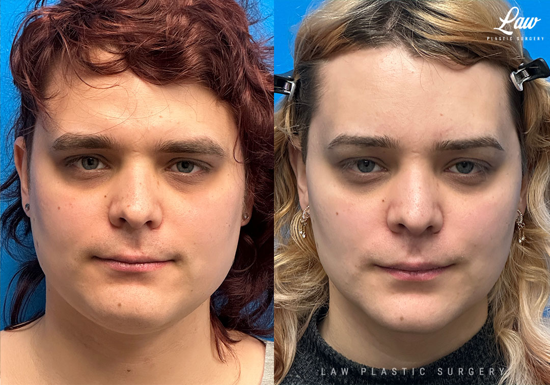 Facial Feminization Before & After Photo. Surgery performed in Dallas, TX at Law Plastic Surgery.
