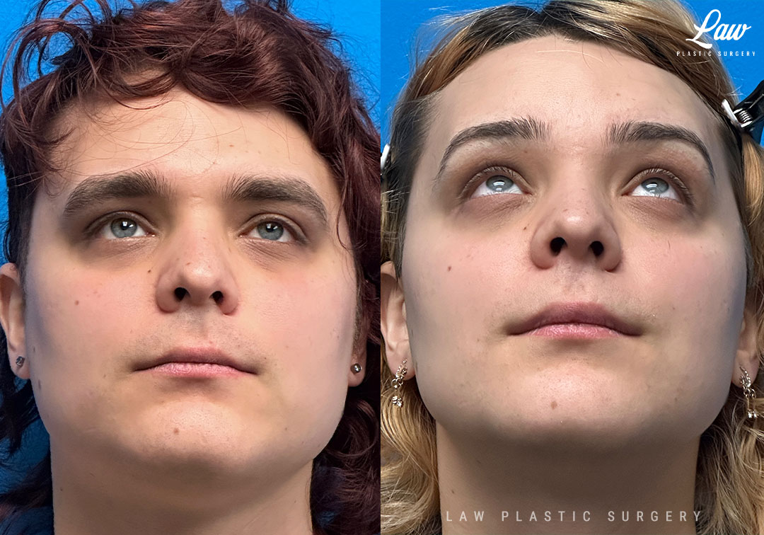 Facial Feminization Before & After Photo. Surgery performed in Dallas, TX at Law Plastic Surgery.