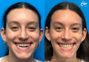 Jaw Surgery Before and After Photo. Surgery performed in Dallas, TX at Law Plastic Surgery.