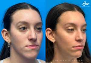 Jaw Surgery Before and After Photo. Surgery performed in Dallas, TX at Law Plastic Surgery.